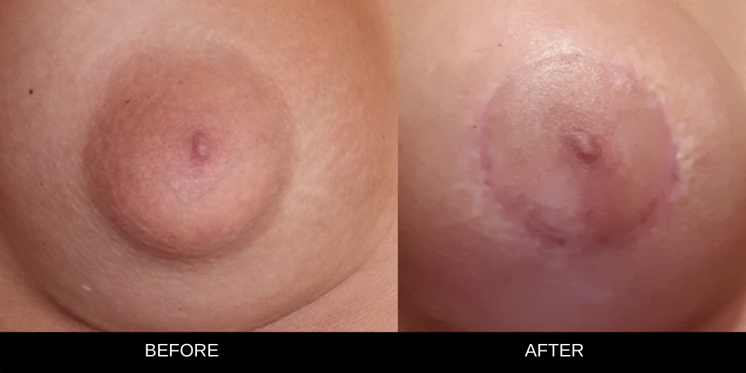 nipple correction areola